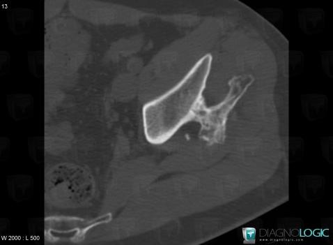 Osteochondroma, Ilium, CT