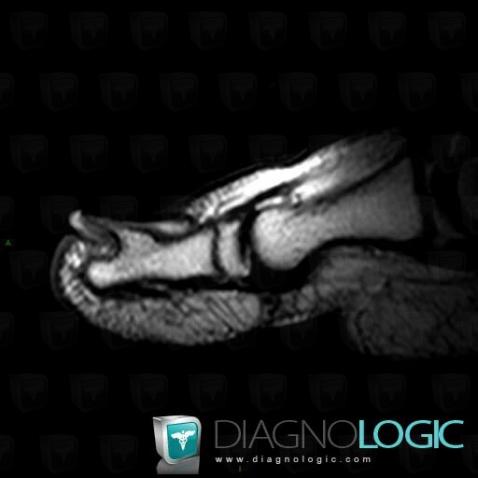 Osteochondroma, Phalanx / Sesamoid bones - Foot, MRI