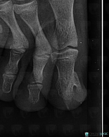 Osteochondroma, Phalanx / Sesamoid bones - Foot, X rays