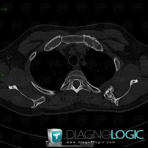 Osteochondroma, Scapula, CT