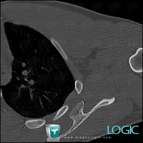 Osteochondroma, Scapula, CT