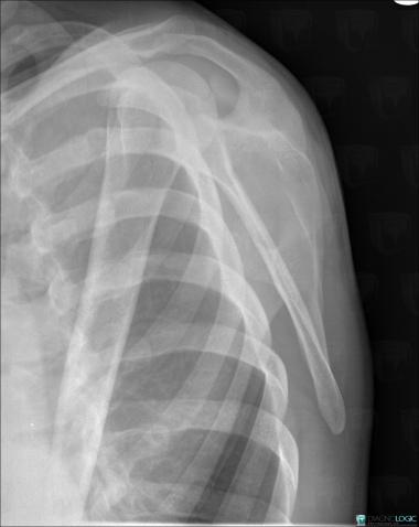 Osteochondroma, Scapula, X rays