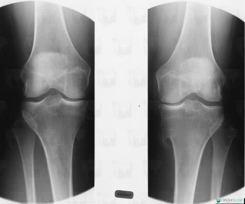 Osteochondroma, Tibia - Proximal part, X rays