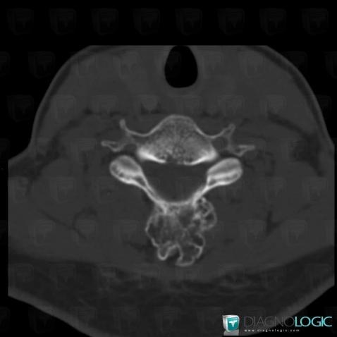 Osteochondroma, Vertebral body / Disk, CT