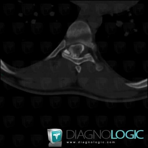 Osteochondroma, Vertebral body / Disk, Spinal canal / Cord, CT