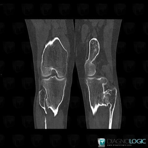 Ostéochondrome , Fibula -supérieur, Scanner