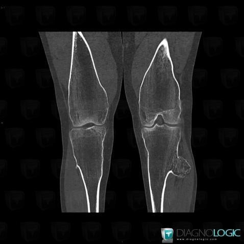 Ostéochondrome , Tibia -supérieur, Scanner