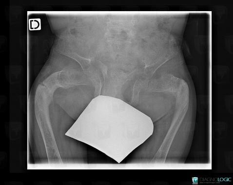 Osteogenesis imperfecta, Ilium, Femur - Proximal part, X rays