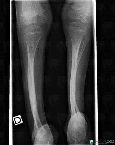 Osteogenesis imperfecta, Tibia - Mid part, Fibula - Mid part, X rays