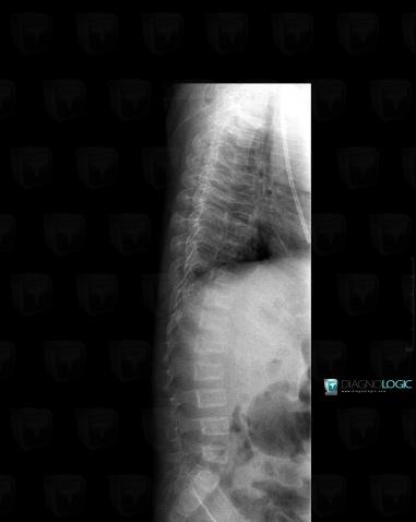 Osteogenesis imperfecta, Vertebral body / Disk, X rays