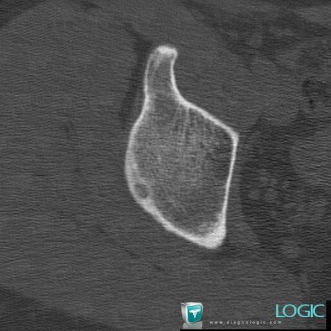 Osteoid osteoma, Ilium, CT