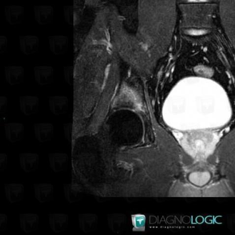 Osteoid osteoma, Ilium, MRI