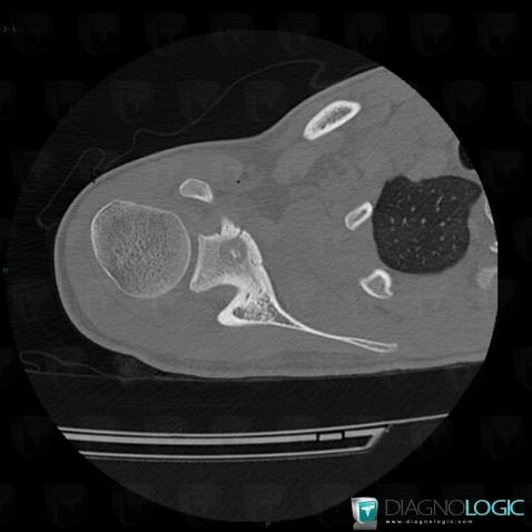 Osteoid osteoma, Scapula, CT