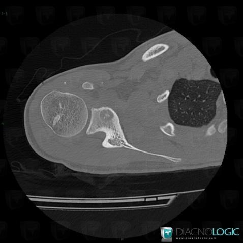 Osteoid osteoma, Scapula, CT