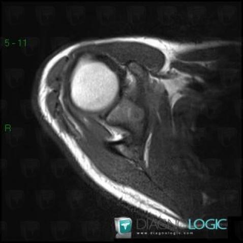 Osteoid osteoma, Scapula, MRI