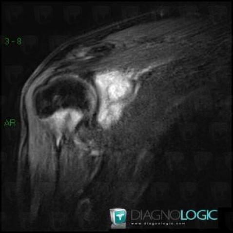 Osteoid osteoma, Scapula, MRI