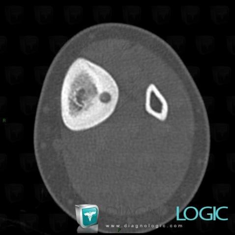 Osteoid osteoma, Tibia - Mid part, CT