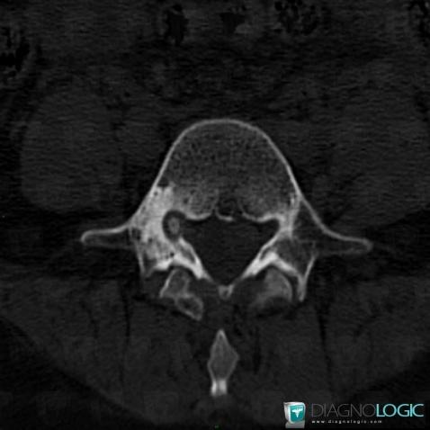 Osteoid osteoma, Vertebral body / Disk, CT