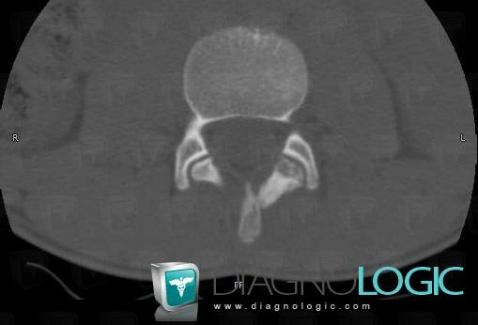 Osteoid osteoma, Vertebral body / Disk, CT