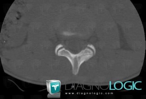 Osteoid osteoma, Vertebral body / Disk, CT