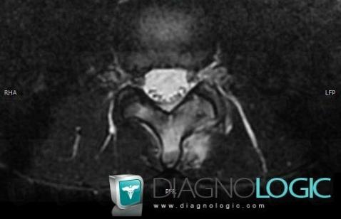 Osteoid osteoma, Vertebral body / Disk, MRI