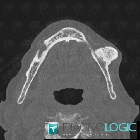 Osteoma, Mandible, CT