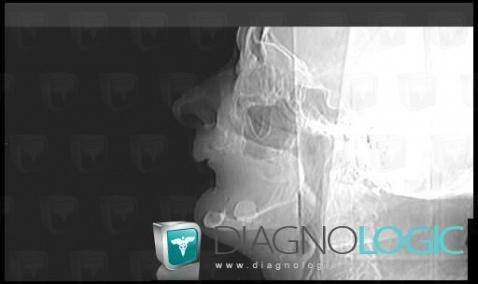 Osteoma, Mandible, X rays