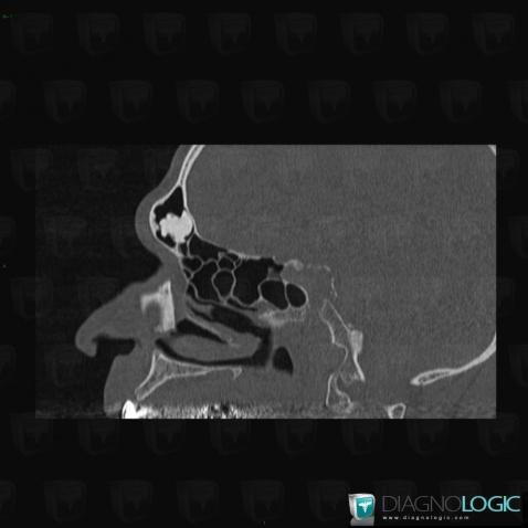 Osteoma, Sinus, CT