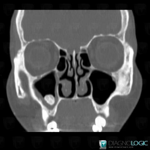 Osteoma, Sinus, CT