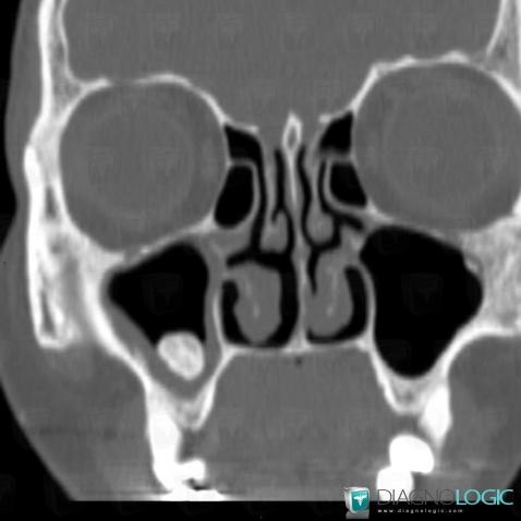 Osteoma, Sinus, CT