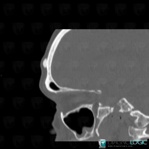 Osteoma, Skull vault, CT