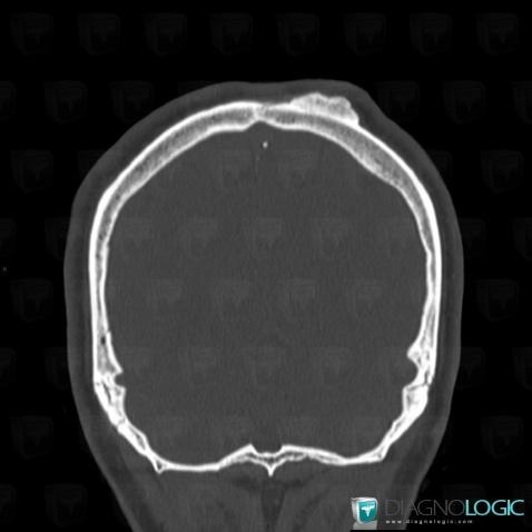 Osteoma, Soft tissues - Skull, CT