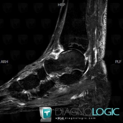 Osteomalacia, Tibia - Distal part, MRI