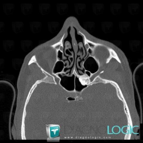 Ostéome , Sinus, Scanner