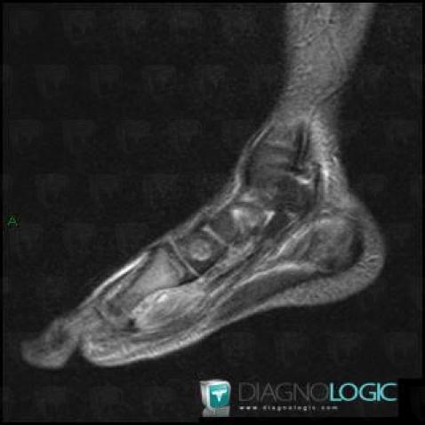 Ostéomyélite, Autres parties molles/nerfs - Pied, IRM
