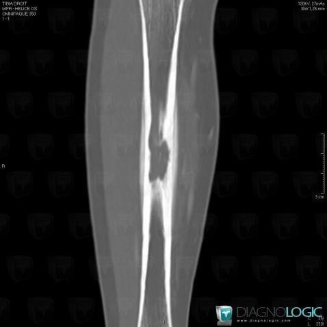 Ostéomyélite, Tibia -moyen, Scanner