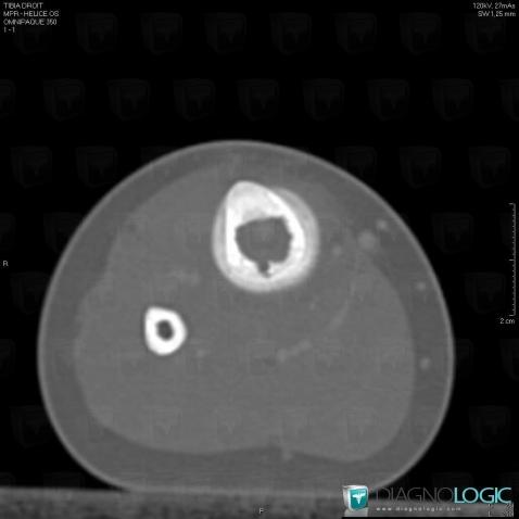 Ostéomyélite, Tibia -moyen, Scanner