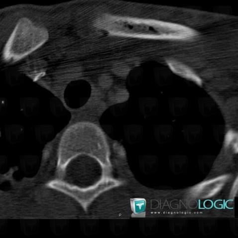 Osteomyelitis, Clavicle, CT