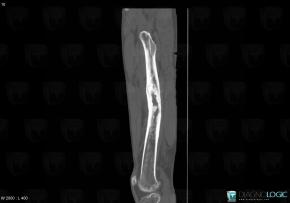 Osteomyelitis, Femur - Mid part, CT