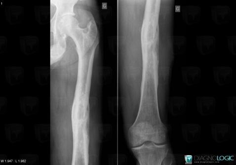 Osteomyelitis, Femur - Mid part, X rays