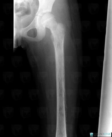 Osteomyelitis, Femur - Mid part, X rays