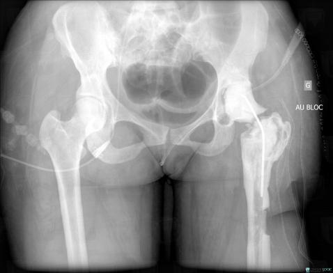 Osteomyelitis, Femur - Proximal part, Femur - Mid part, X rays