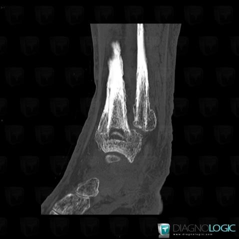 Osteomyelitis, Fibula - Distal part, CT