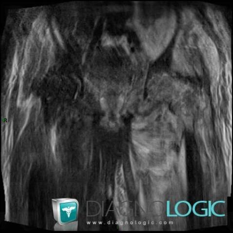 Osteomyelitis, Fibula - Proximal part, MRI