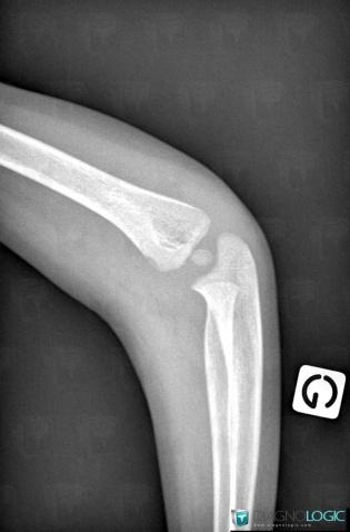 Osteomyelitis, Humerus - Distal part, X rays