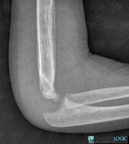 Osteomyelitis, Humerus - Distal part, X rays