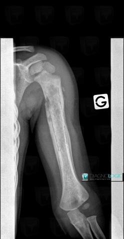 Osteomyelitis, Humerus - Mid part, X rays