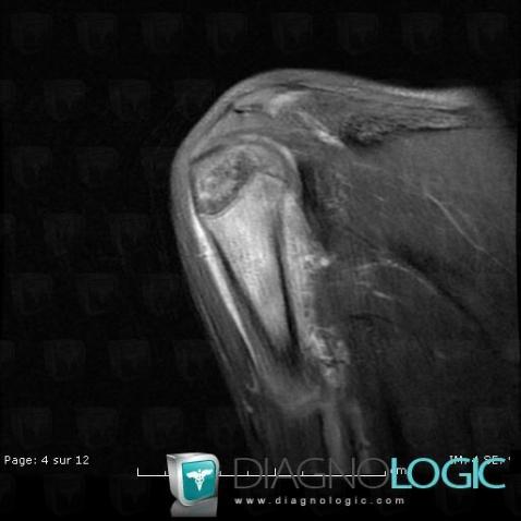 Osteomyelitis, Humerus - Proximal part, MRI