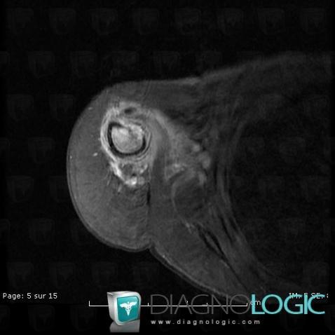 Osteomyelitis, Humerus - Proximal part, MRI