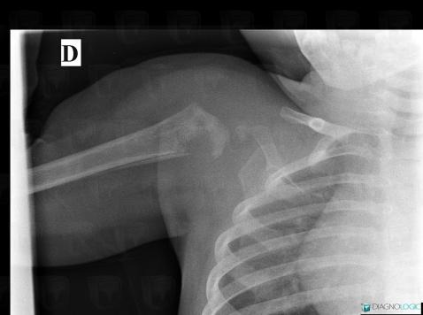 Osteomyelitis, Humerus - Proximal part, X rays